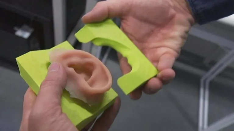 Orecchio ricostruito con la stampa 3D a pazienti affetti da microtia